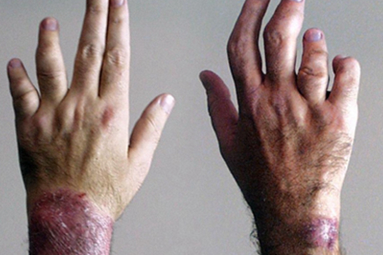 银屑病关节炎畸形图