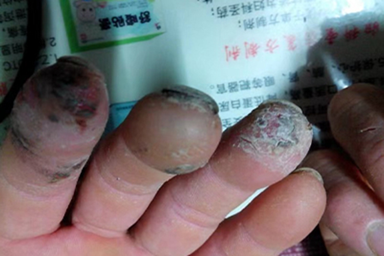 皮肤皲裂手指尖症状图