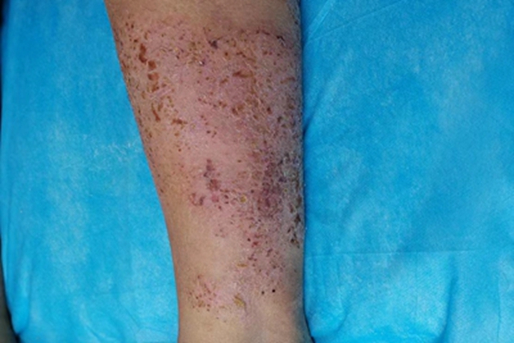 亚急性湿疹小腿粗糙结痂图 亚急性湿疹小腿粗糙结痂图