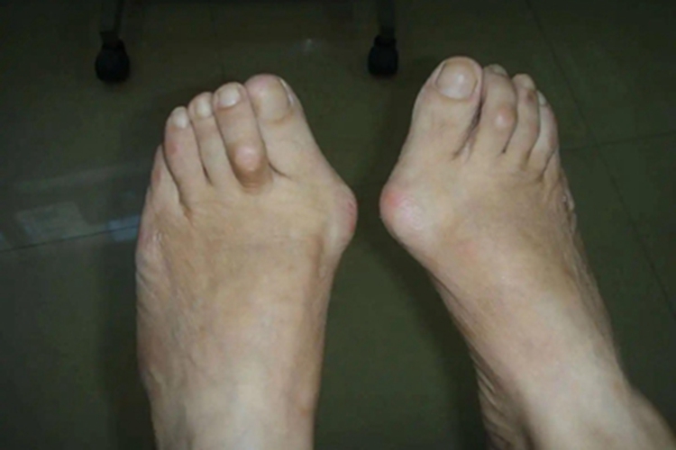 拇趾滑囊炎大包图 拇趾滑囊炎大包图