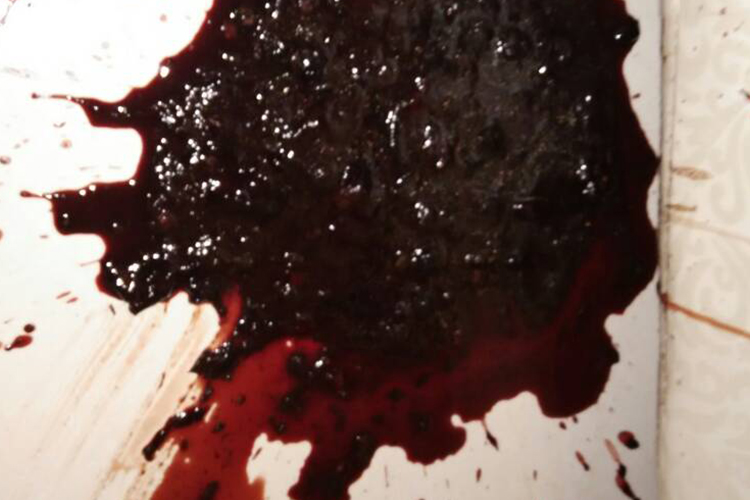 肺癌晚期咯血图