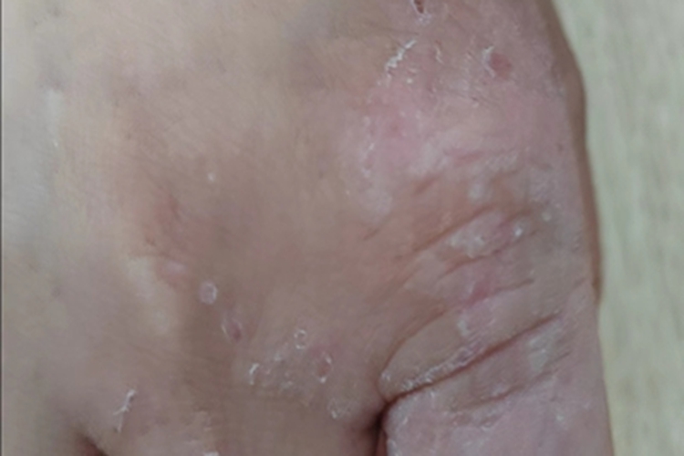 局限性神经性皮炎手指脱屑图 局限性神经性皮炎手指脱屑图