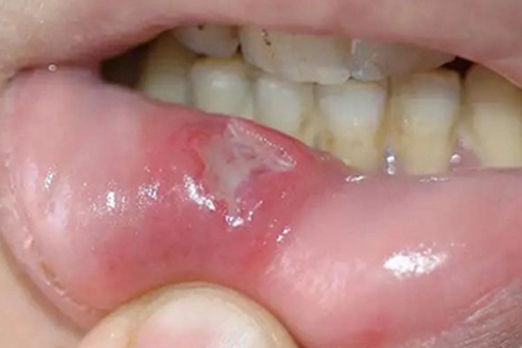 重型阿弗他溃疡图