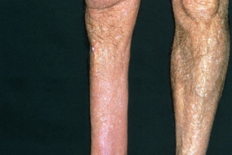 萎缩性慢性肢端皮炎症状图