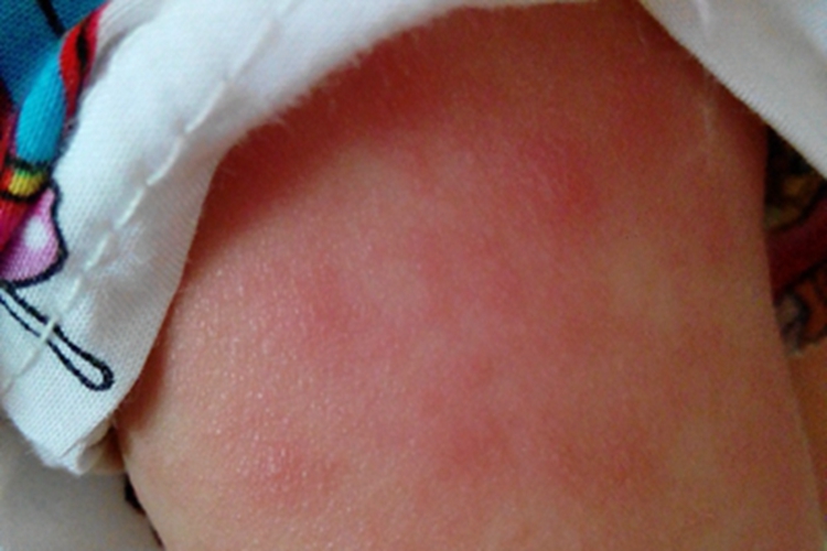 红痱大腿症状图