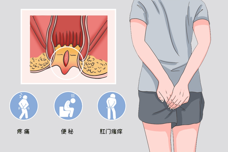 宝宝肛裂前哨痔图片图片