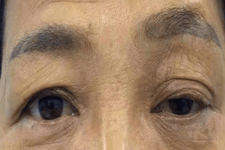 上睑下垂眼睛睁不开图