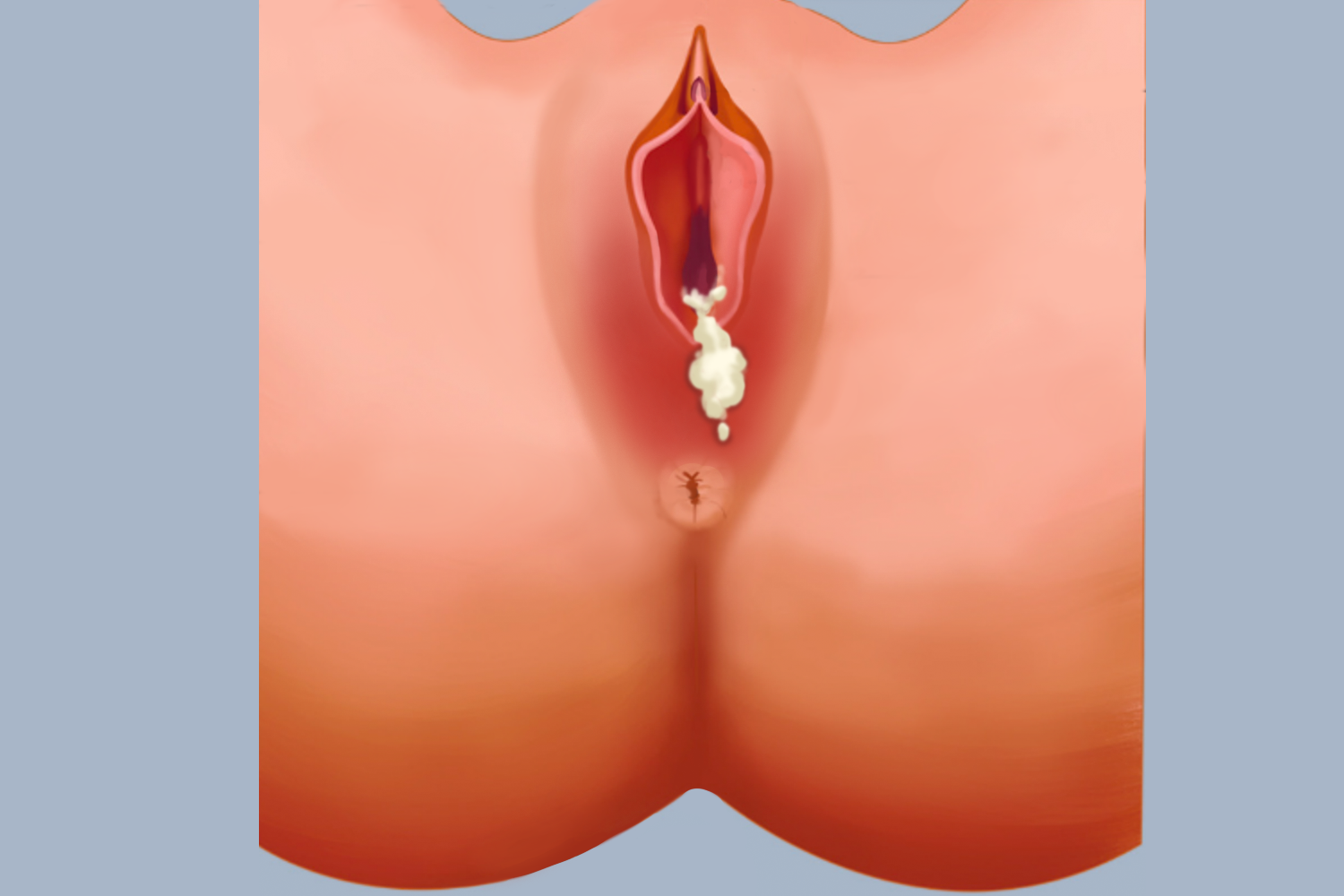 女性生殖道衣原体感染手绘图