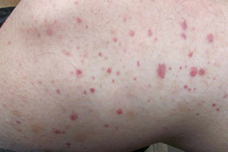 炭疽病膝盖症状图