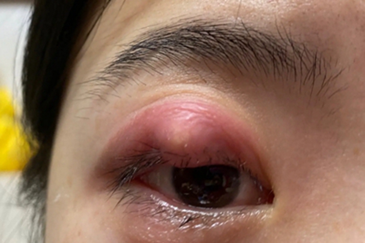 睑板腺炎可累及眼睑局部出现凸起的硬结,大小不一,可逐渐软化,化脓并