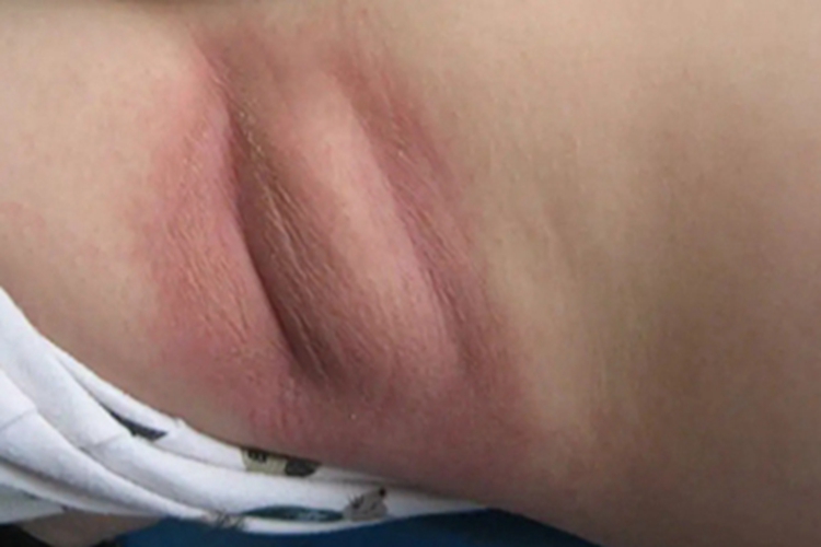 急性接触性皮炎腋窝红斑图