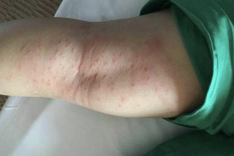 婴儿特应性皮炎丘疹图 婴儿特应性皮炎丘疹图