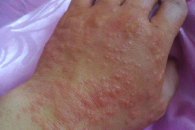 手背湿疹红斑水疱图