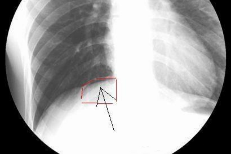 单侧肠穿孔X线图 单侧肠穿孔X线图