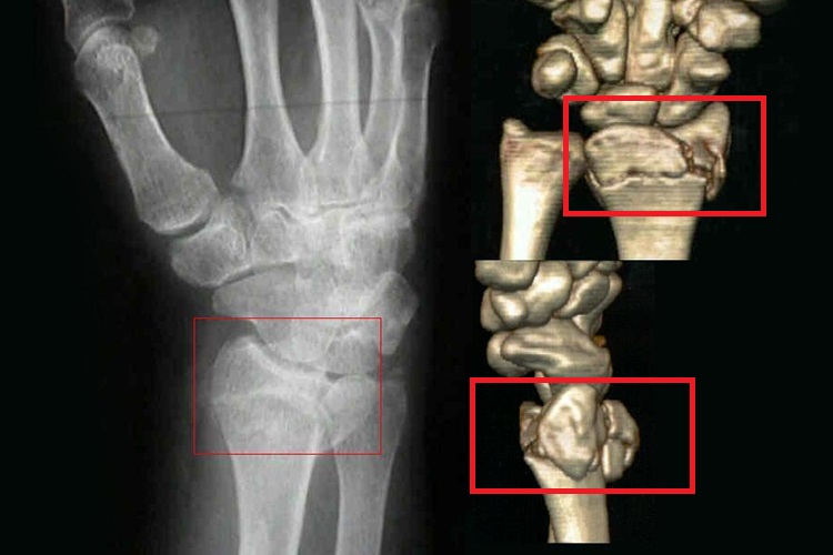 巴通氏骨折影像学图