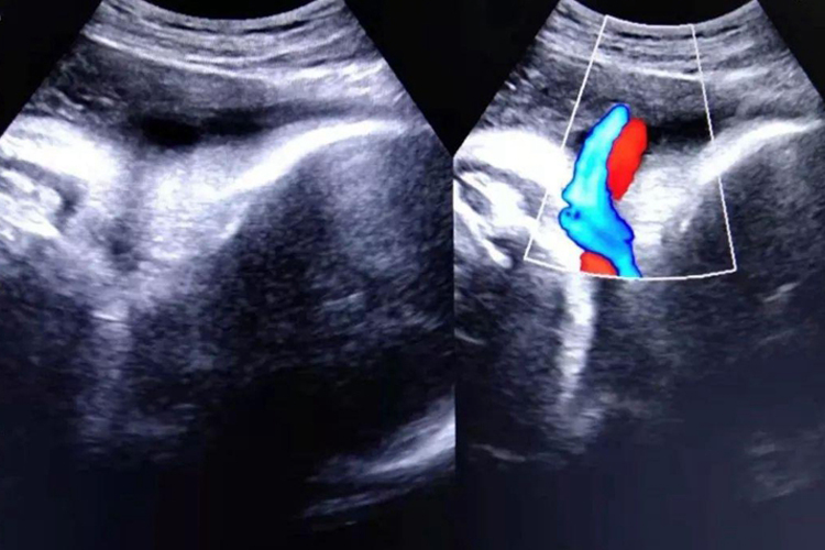 脐带绕颈超声图 脐带绕颈超声图