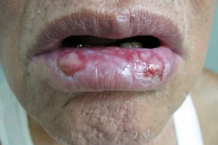 变应性接触性唇炎嘴里烂了图