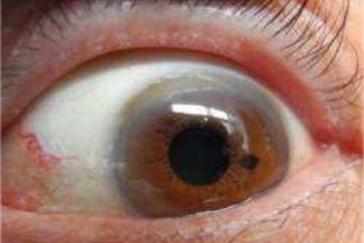 眼眶毛细血管瘤症状图 眼眶毛细血管瘤症状图