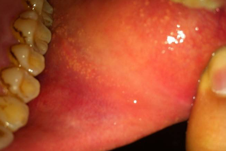 口腔内壁有黄点颗粒状图