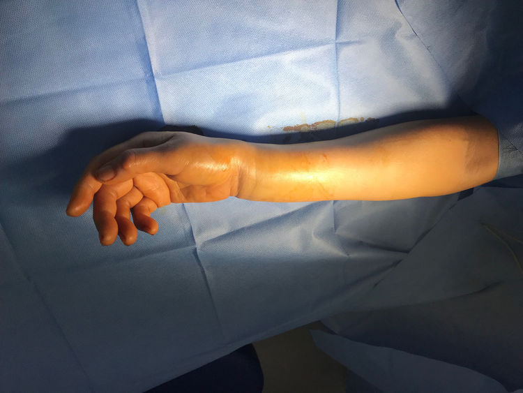 尺桡骨远端骨折手肿图 尺桡骨远端骨折手肿图