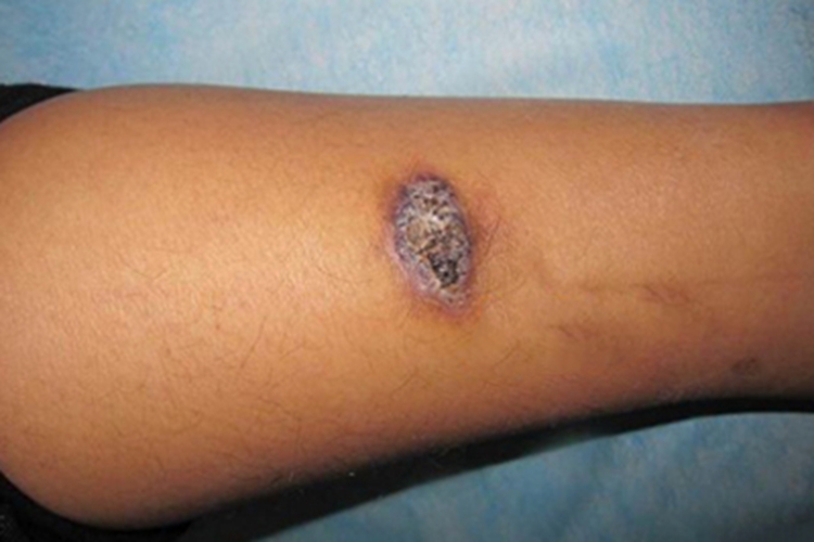 局限性血管角皮瘤小腿疙瘩结痂图