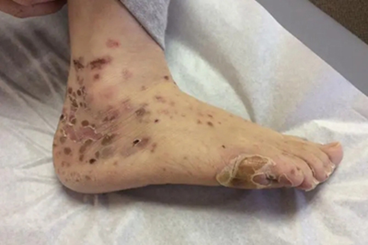 副肿瘤性天疱疮脚部症状图 副肿瘤性天疱疮脚部症状图