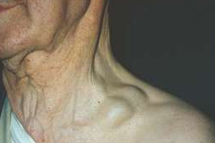 恶性肿瘤淋巴结转移图