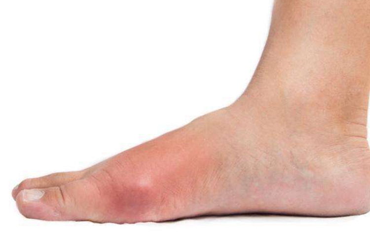 尿酸高脚上症状图