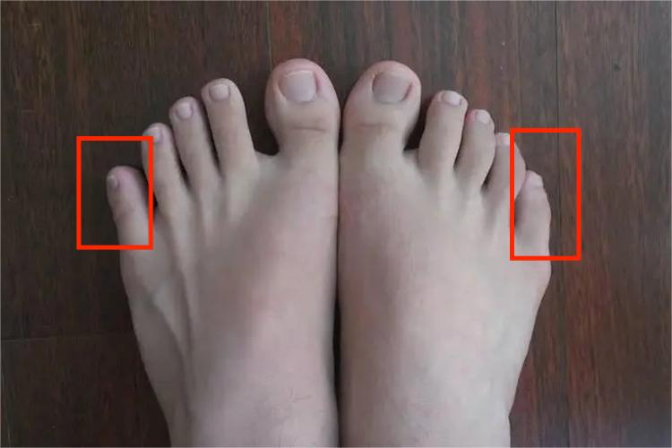 小脚趾正常图