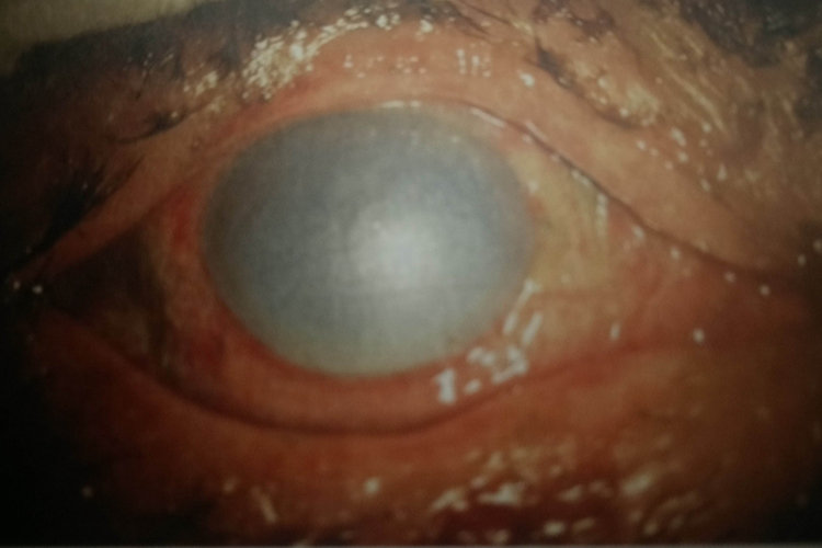 中度眼角膜碱性烧伤图