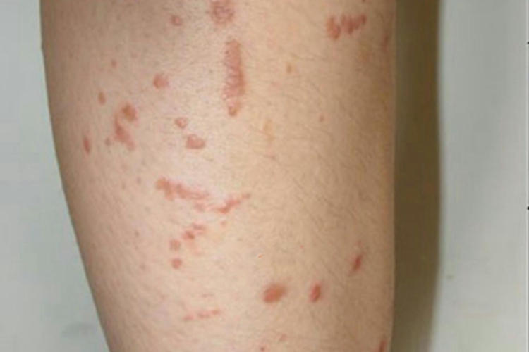 扁平疣小红疙瘩图