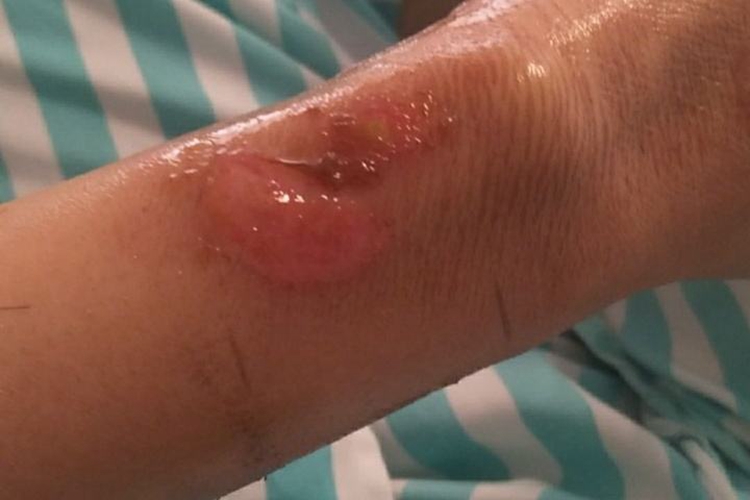 轻度火疮局部肿胀图 轻度火疮局部肿胀图