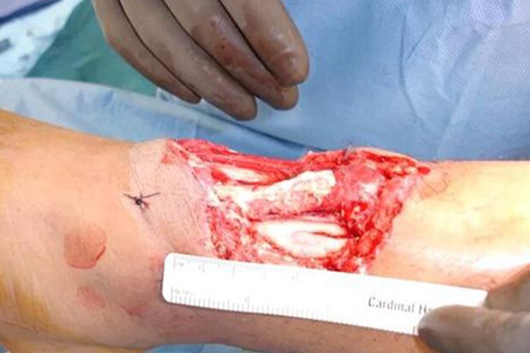 第二度开放性骨折图