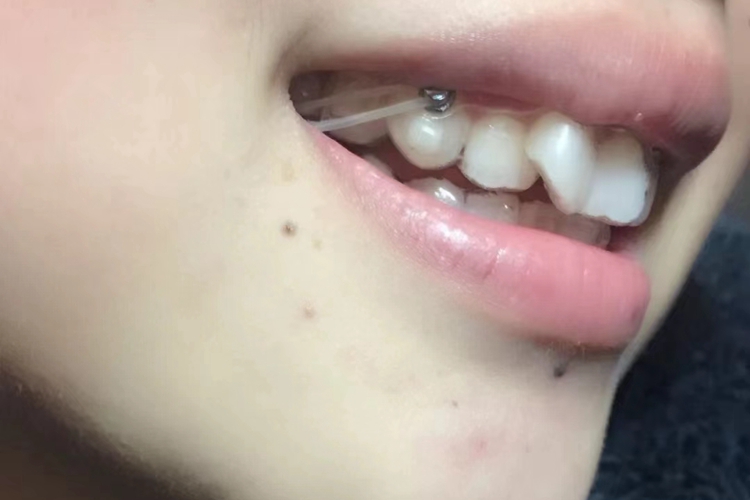 门牙往里凹图 门牙往里凹图