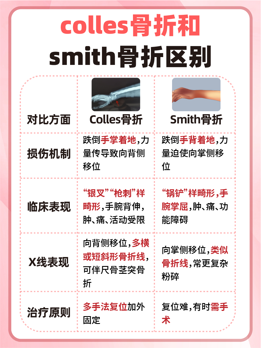 揭秘:colles骨折和smith骨折区别