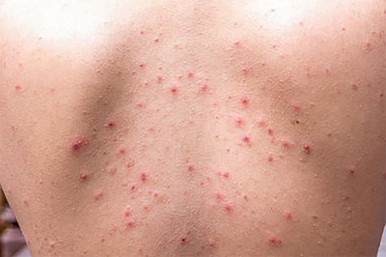 荨麻疹皮肤出血点图
