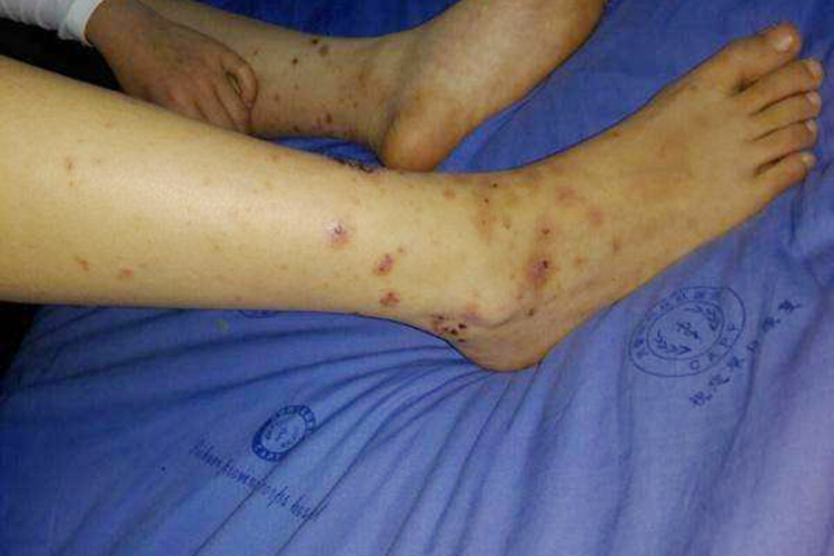 坏血病引起皮肤瘀斑图 坏血病引起皮肤瘀斑图