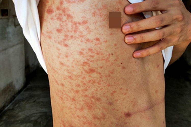 过敏性皮炎身上长满红斑图