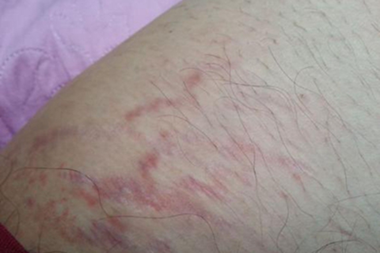 匍行性血管瘤大腿症状图