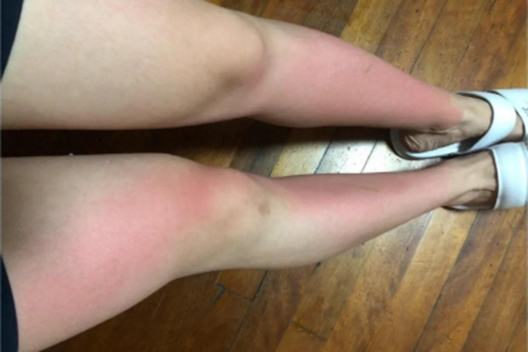 皮肤过敏红肿腿红肿图