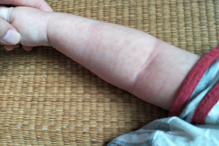 幼儿急疹胳膊皮疹图