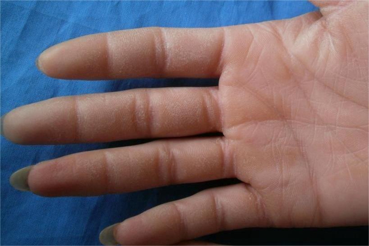 掌跖角皮症手指皮肤发黄图