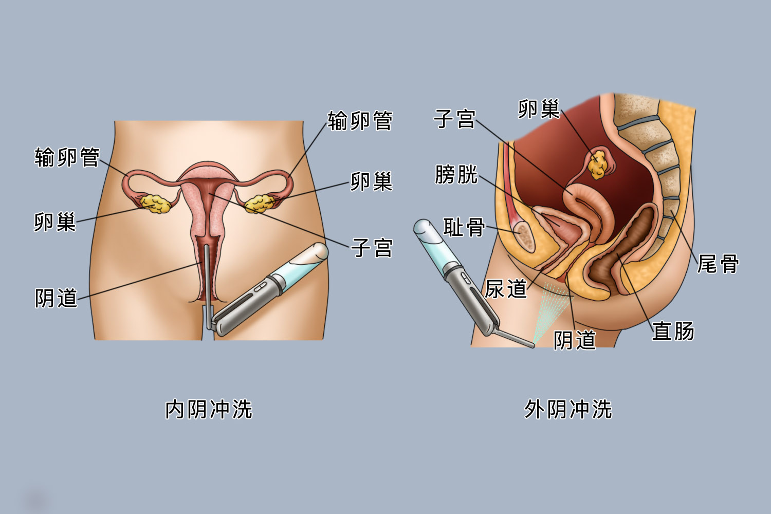冲洗外阴及阴道图