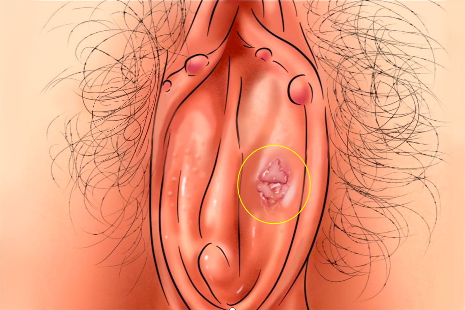 性病型急性女阴溃疡大阴唇溃疡图