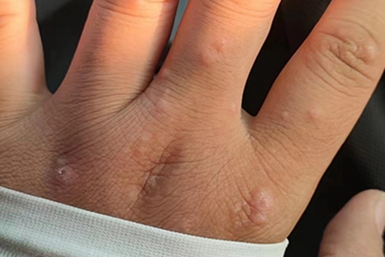 过敏性皮炎左手背长疙瘩图