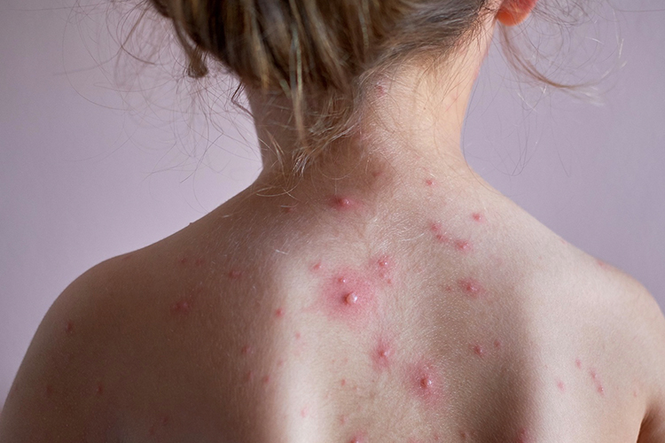 长水痘的初期症状