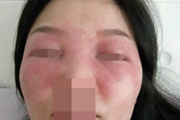 糖皮质激素依赖性皮炎红肿图