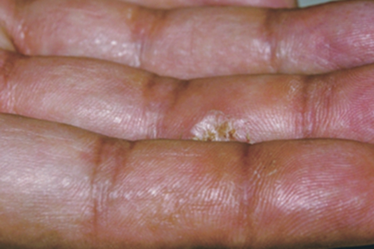 肢端角化性类弹性纤维病小疙瘩图