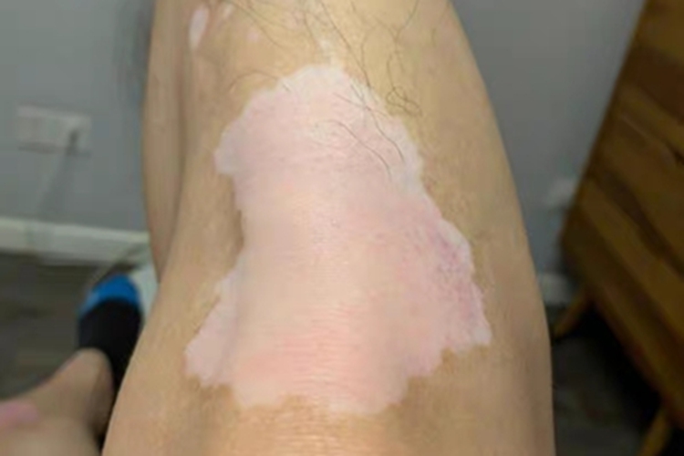 非节段型白癜风腿部长斑图