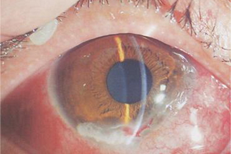 角膜变性角膜水肿图